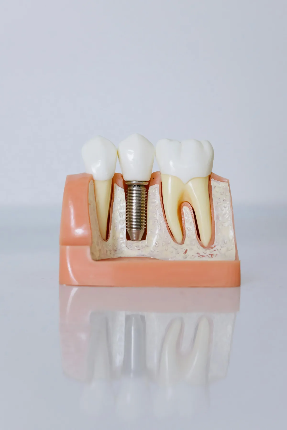 Types of Dental Implants: Which Is Right for You?